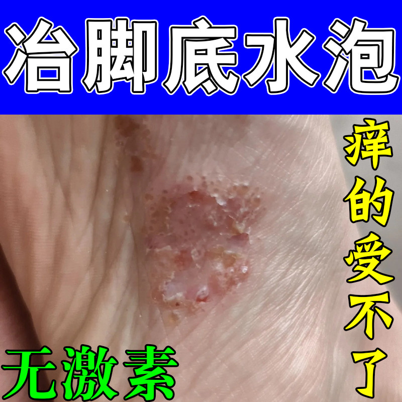 脚底密集小水泡干痒蜕皮难忍起皮干燥粗糙角质层增厚草本软膏