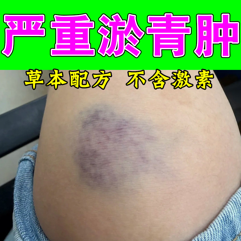 撞伤淤青明显发紫活血化瘀膝盖摔磕碰撞伤发紫红肿胀痛散淤外用膏