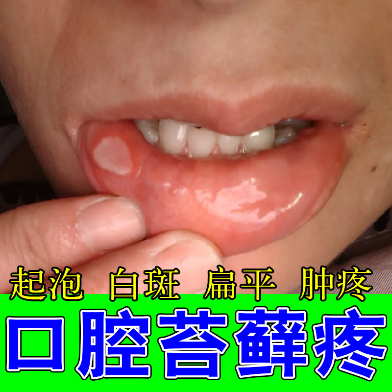 口腔白斑疼痛黏膜舌苔厚白口舌起泡熬夜上火口腔黏膜肿痛出血喷剂