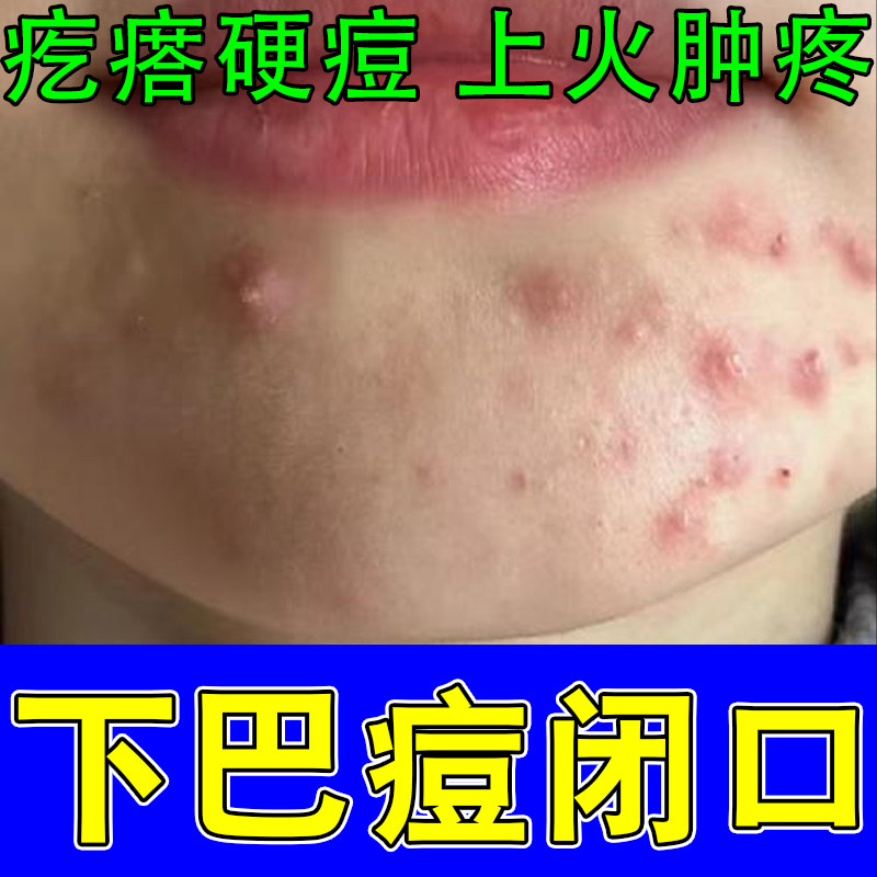 下巴闭口粉刺脸上额头包硬块内分泌失调粉刺疙瘩红痒修护保湿膏