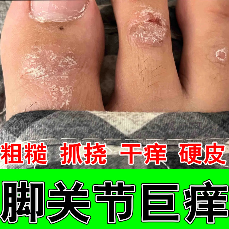 脚面发痒红肿结痂干燥起屑脚背起皮干燥有红疙瘩草本修护保湿软膏