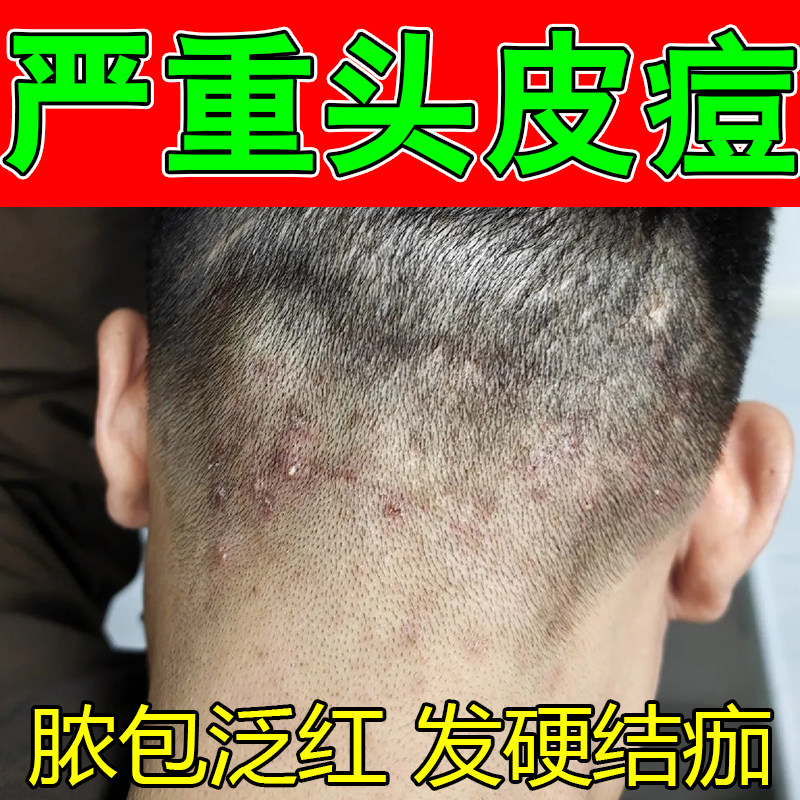 冶头上红疙瘩长痘头部头皮痒有疙瘩红肿后脑勺硬块草本修护软膏