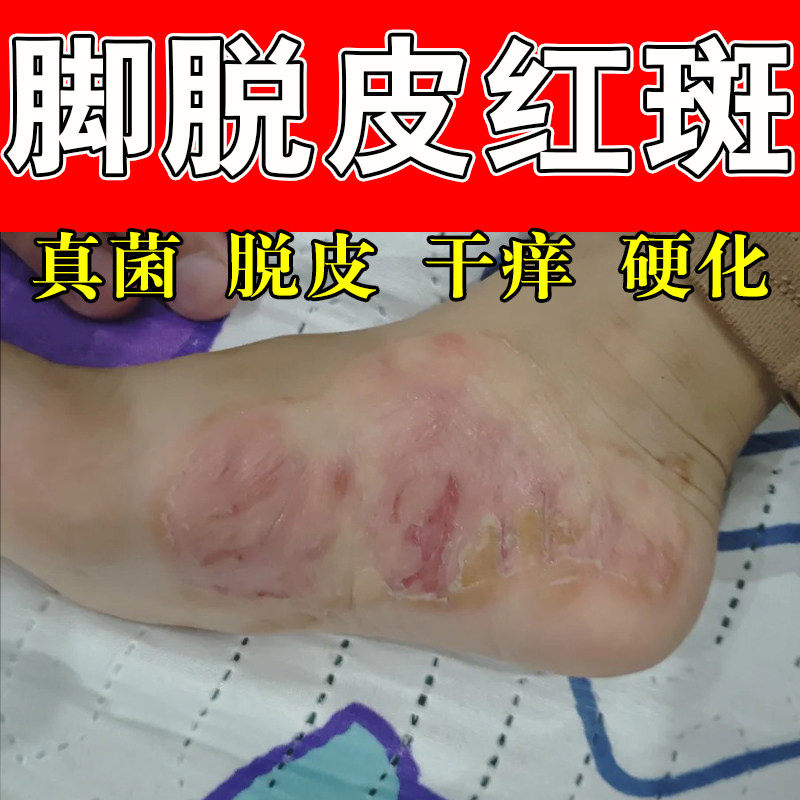 冶脚底侧干痒脱皮红神经痒脚侧痒刺挠粗糙疙瘩起皮干痒修护膏