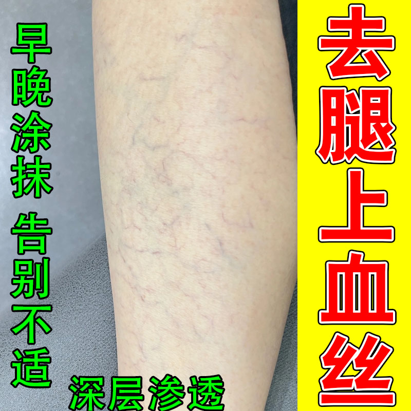 腿上青筋凸起长红血丝腿皮肤血丝扩张青筋凸起血管扩张草本乳膏