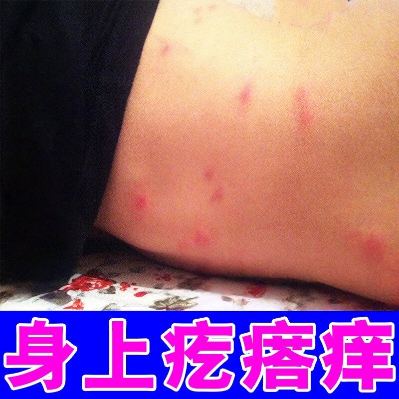 治皮痒小孩身上起红疙瘩痒后背起红斑丘诊痒止软膏痒
