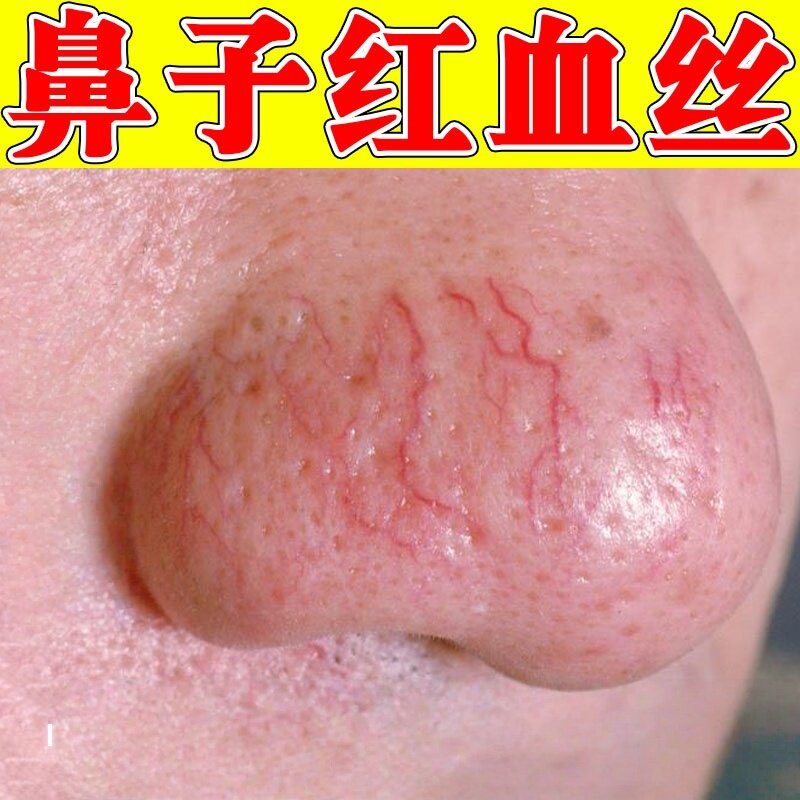 去鼻子红血丝酒糟鼻修复红鼻子草莓鼻黑头除螨毛孔粗大脂溢性皮延
