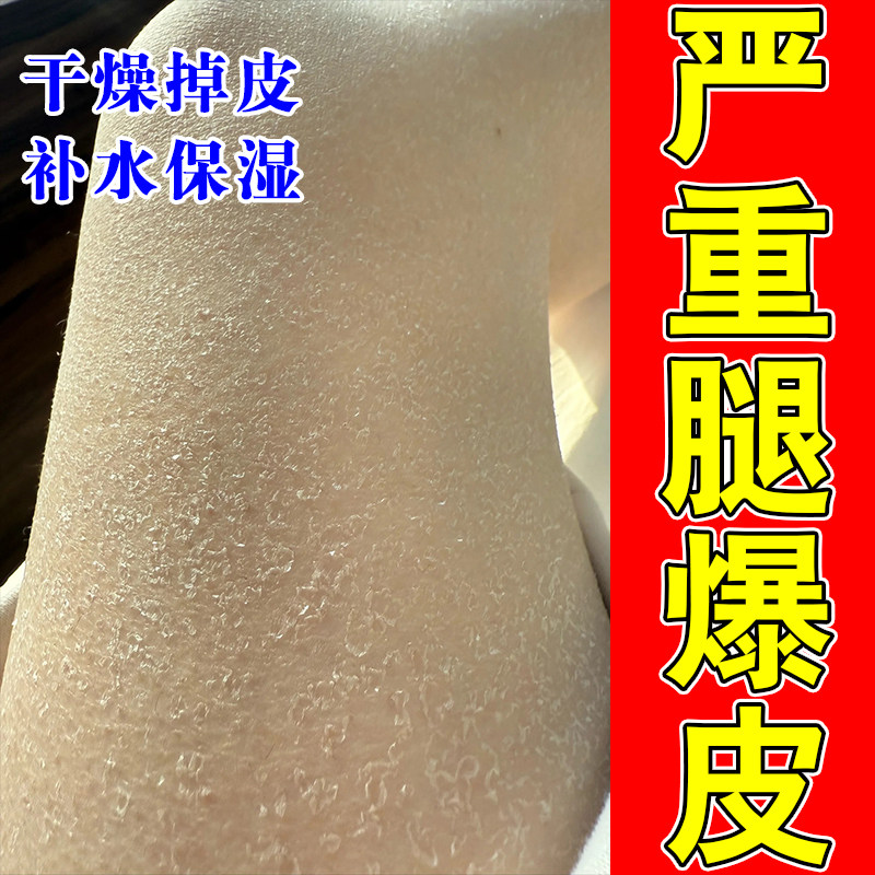 腿上干燥起皮小腿皮肤粗糙干裂成人身上掉皮屑起皮保湿甘油
