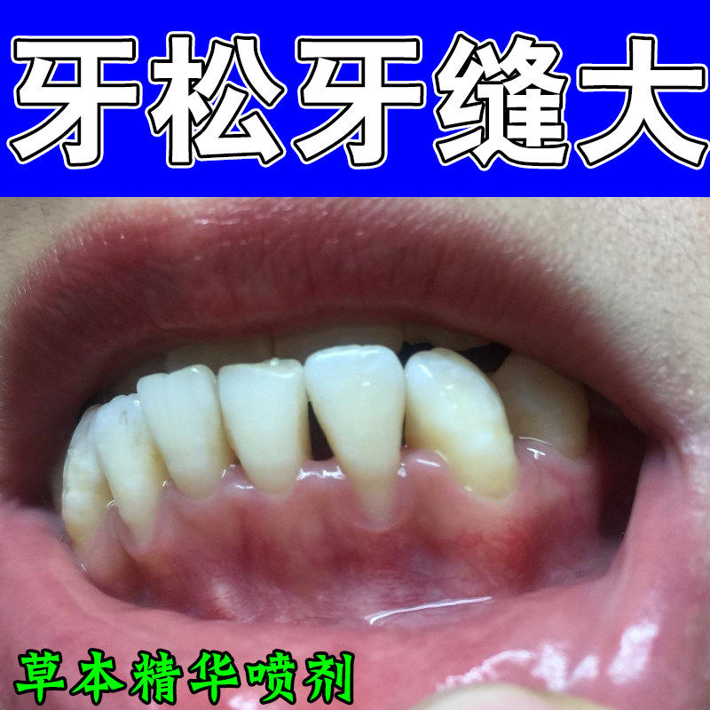 牙齿牙龈收缩牙松动牙龈红肿敏感牙龈频繁出血专用口腔护养喷剂