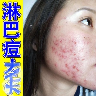 去淋巴痘腮边痘下巴痤疮腮帮子脸上长痘痘闭口粉刺脓包红肿毛囊焱