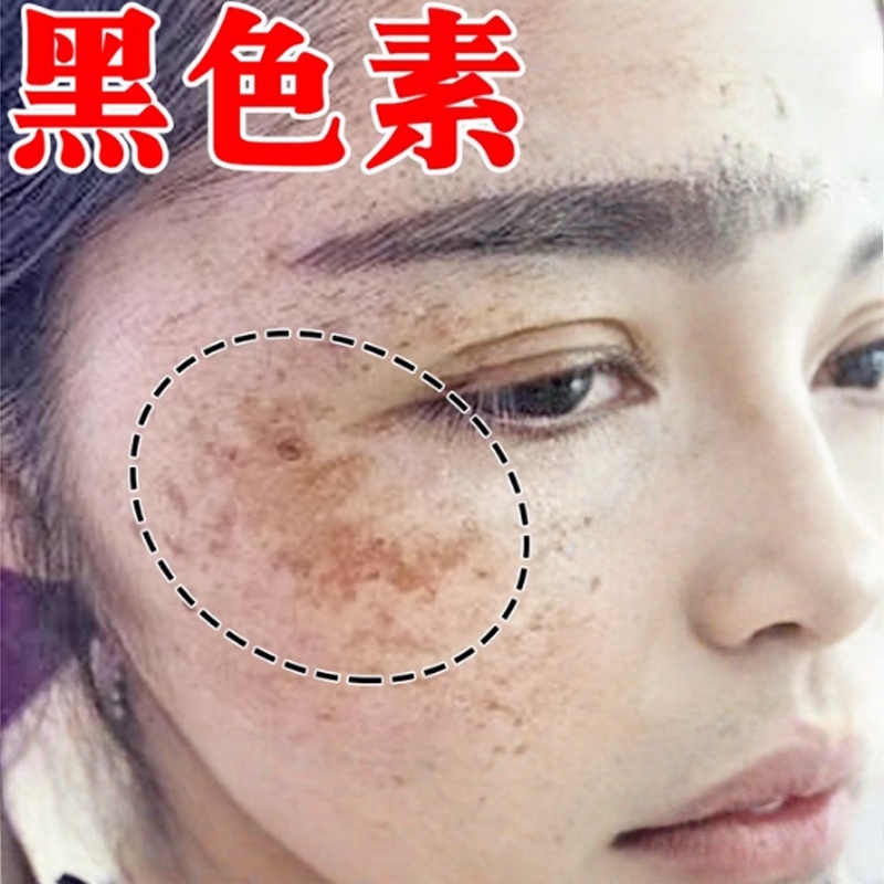 脸上黑色素沉淀去除祛专班用软膏老年班去除黄褐班雀色斑淡化软膏