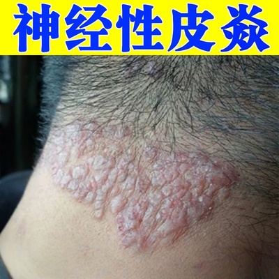 神经性皮焱中医治外用除膏顽固无激素藓诊痒湿止感染真菌脖子痒