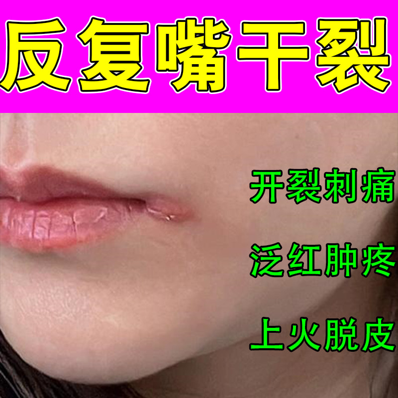 冶嘴角疼肿结痂专用防嘴唇干裂脱皮用型儿童修复剥脱性结痂疼膏