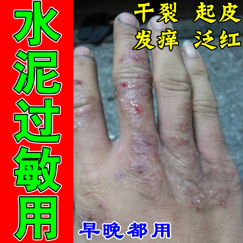水泥过敏长期碰水泥手痒红肿脱皮干裂手粗糙刺痛草本舒缓保湿软膏