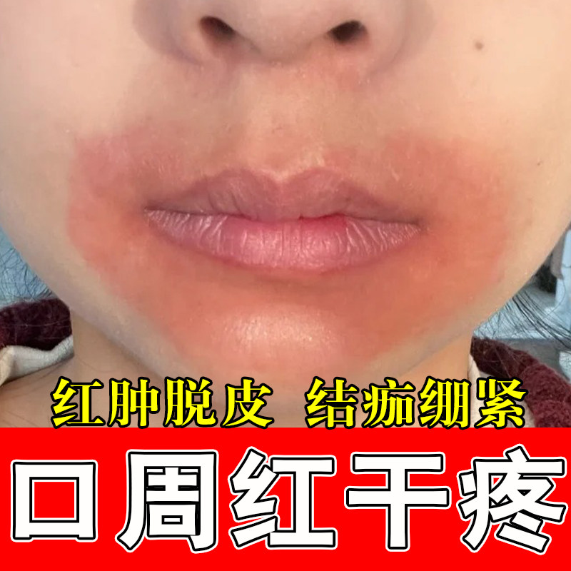 小孩口周泛红结痂干痛频繁舔嘴嘴角起皮肌肤不适红肿结痂疼修护膏