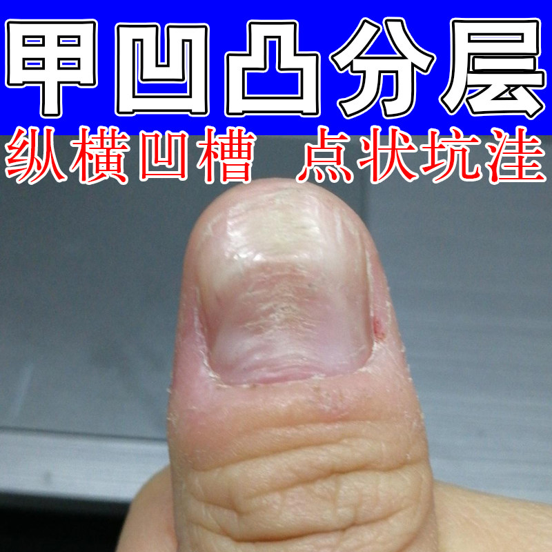 专冶指甲凹凸不平开裂空甲指甲受损变形甲面有竖纹分层草本修复液