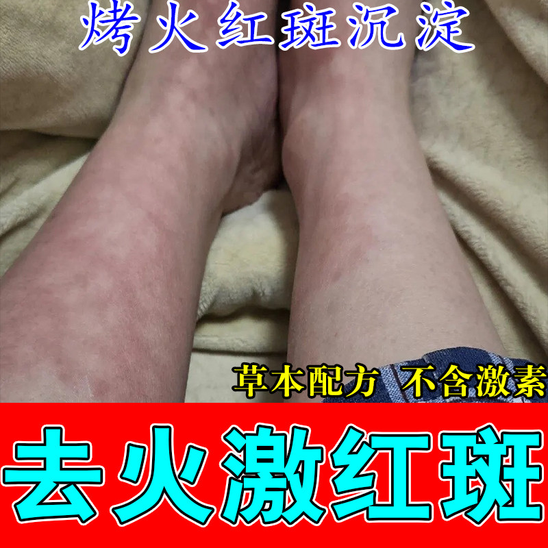 火激红斑腿上纹路烤火高温灼伤腿部起水泡网状斑毛细血管褪红用膏