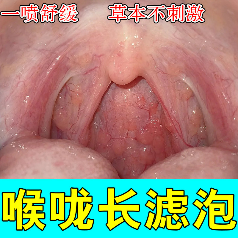 咽喉滤泡不适咽喉淋巴滤泡增生喉咙疙瘩发红灼热异物感温和喷剂