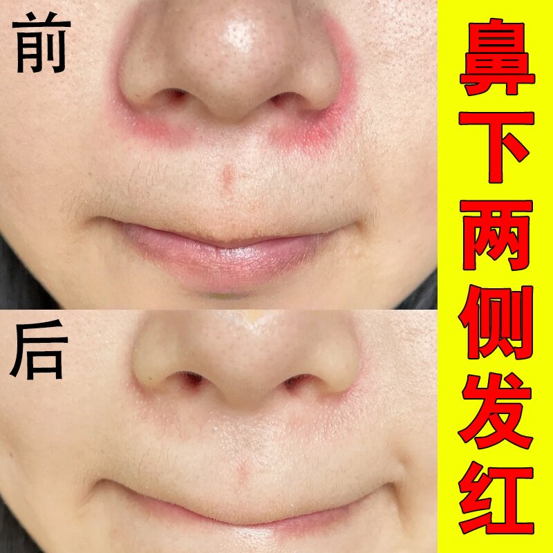 鼻子红血丝修复去除鼻下鼻翼两侧泛红毛孔粗大草莓酒糟鼻脓包