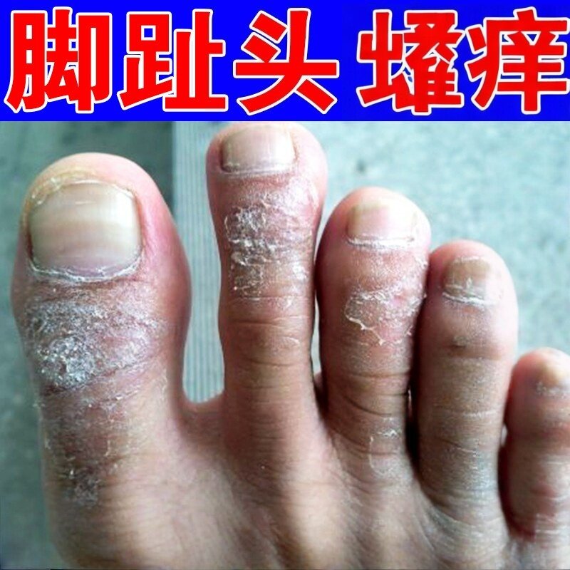 脚趾头脚背上痒刺挠感真菌神经/性/皮/脚指脱皮干痒软膏