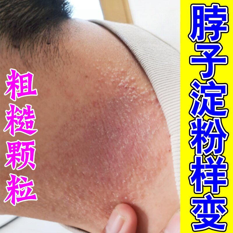 皮肤淀粉样变专用膏治顽固脖子手臂上小颗粒疙瘩痒粗糙色素沉淀