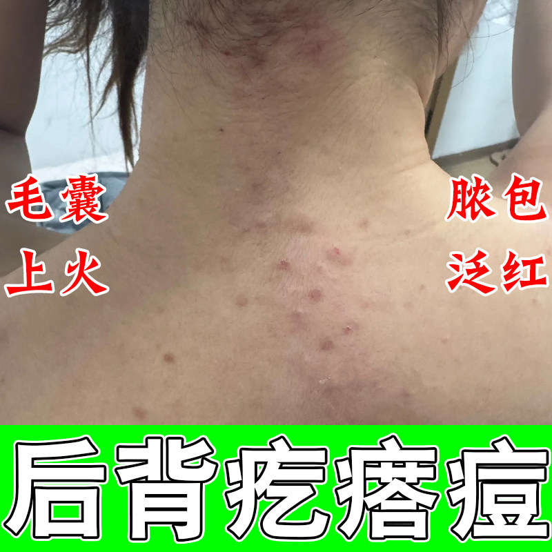 后背背上长痘毛囊痘疙瘩密集红痒皮肤粗糙疙瘩疼红草本修护软膏