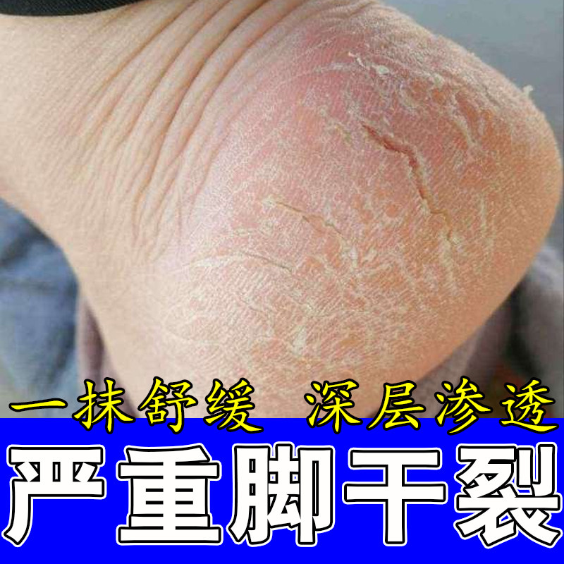 脚干燥起皮粗糙脚后跟反复裂口粗糙老茧脱皮草本温和舒缓保湿膏
