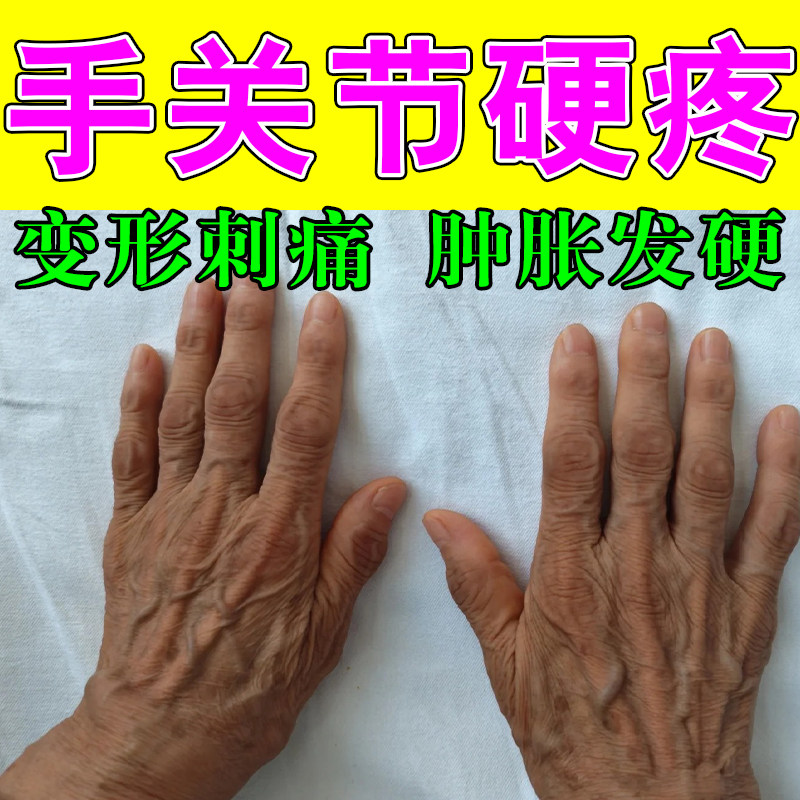 手指粗大指关节手指骨节肿胀鼓包手指僵硬弯曲困难草本修护膏