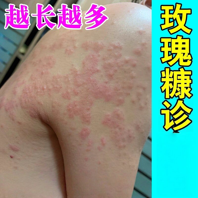 玫瑰糠专诊用身上长红斑丘感真菌神经/性/皮/痒外用膏