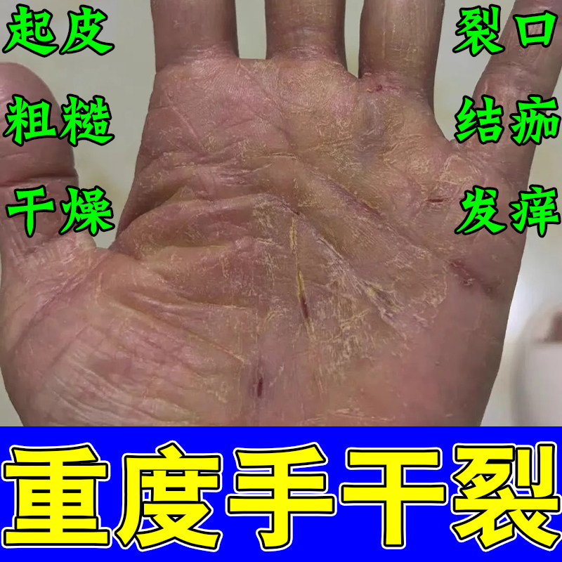 冶手干燥粗糙起干皮干裂痒角质厚增生发痒干燥结痂发硬干皮裂口膏