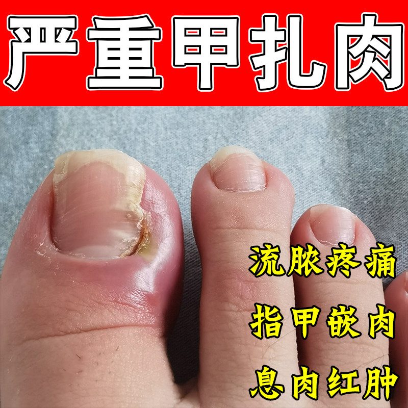 甲沟红肿疼息肉膏冶手脚指甲旁红肿发红肿大化脓痛草本修护膏
