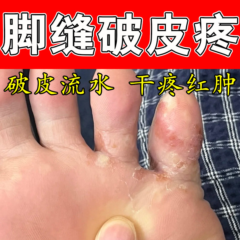 冶脚缝破皮痒手指间起皮经常碰水起皮手丫膏脱皮真菌草本保湿膏