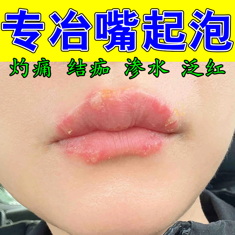 唇周起泡干裂起皮舒缓上火起小泡改善嘴角泛红粗糙温和修护唇膏
