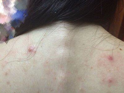 屁股上长疙瘩牛皮癣藏研一芥灵抑菌霜一疥灵抑菌霜介疮疥灵霜软药