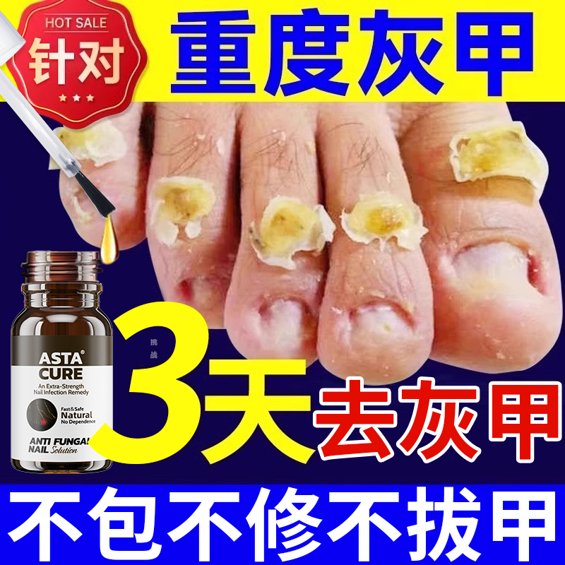 【自营】灰指甲特效药根治第一名专用药正品官方旗舰店亮治疗1甲