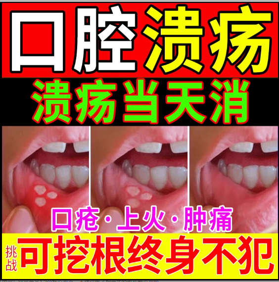 【自营】口腔溃疡专用药特效药一点灵药膏贴西瓜霜舌头溃疡灵口疮
