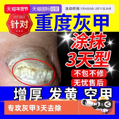 灰指甲特效专用正品官方旗舰店药治疗灰甲进口阿莫罗芬搽剂亮甲