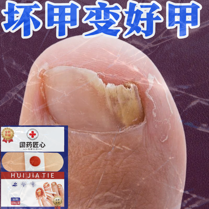 【中国大药房】指甲贴正品专用贴植物萃取脚趾手指甲专用