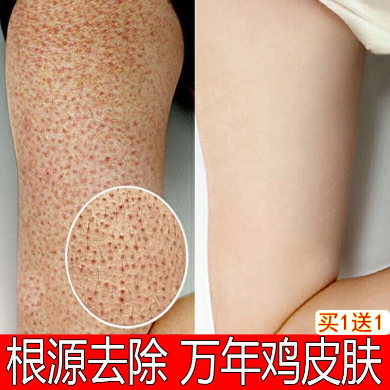 后背像鸡皮肤一样一抓掉皮(背上跟鸡皮肤一样的什么原因) 后背像鸡皮肤一样一抓掉皮(背上跟鸡皮肤一样的什么原因)