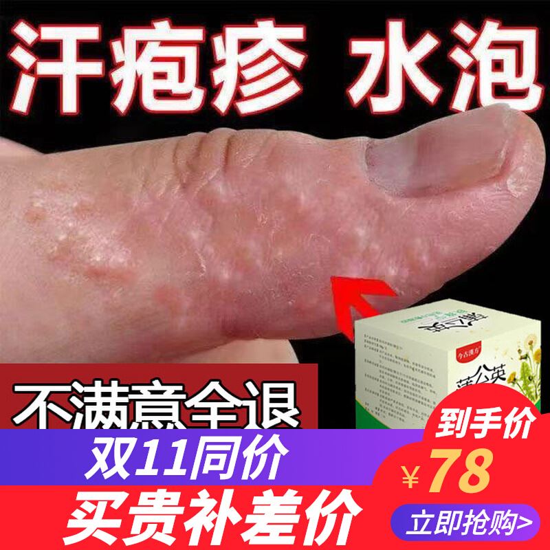 儿童手上起小水泡汗状型手痒软膏汉状汗泡专用汗孢