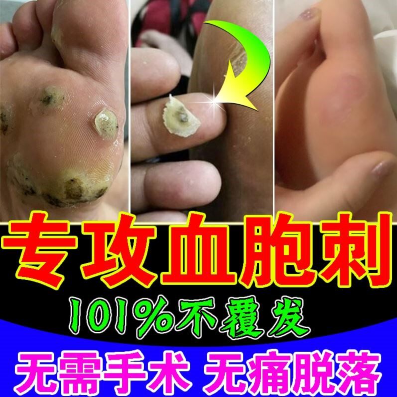 血胞刺去除膏治疗跖疣特效药足部脚肉刺祛血泡刺贴鸡眼老茧的神器