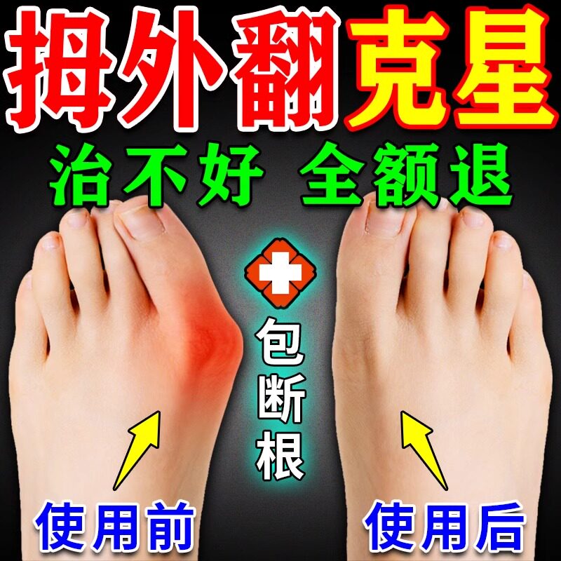 同仁堂拇指外翻药膏贴大母脚趾拇外翻矫正器女士大脚骨专用神器