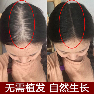 那非雄胺片保法止 非那雄胺片保法治菲娜雄安片进口药保止法脱发