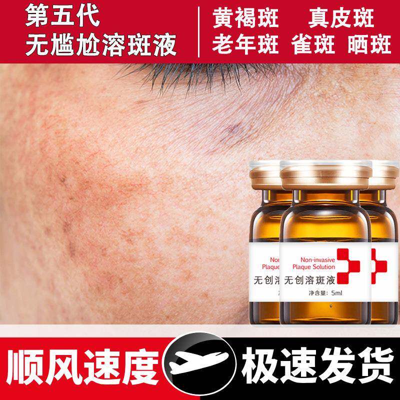 无创溶斑液淡化斑点去黄褐斑真皮斑雀斑美白精华液油祛斑液排色液