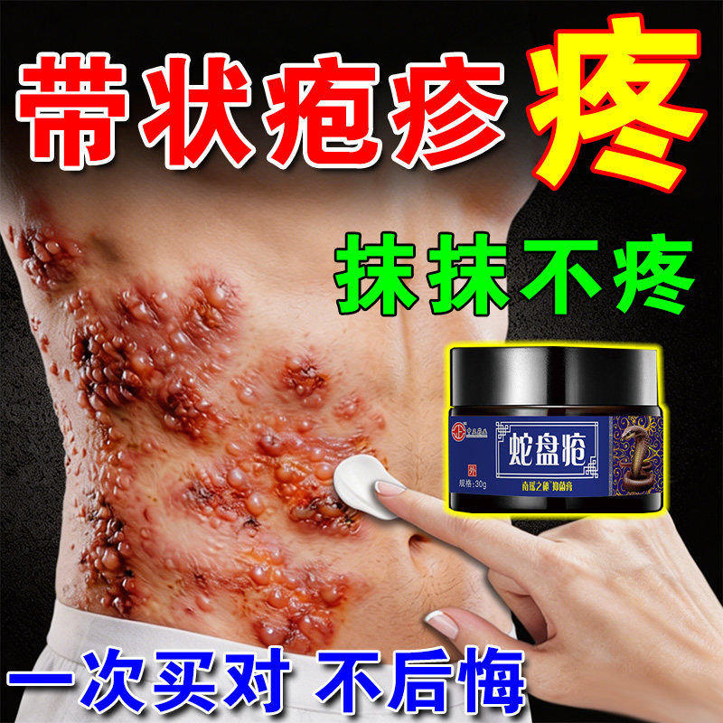 蛇盘疮带状疱疹后遗症神经痛专用膏药止痒止痛缠腰胆疮外用药膏