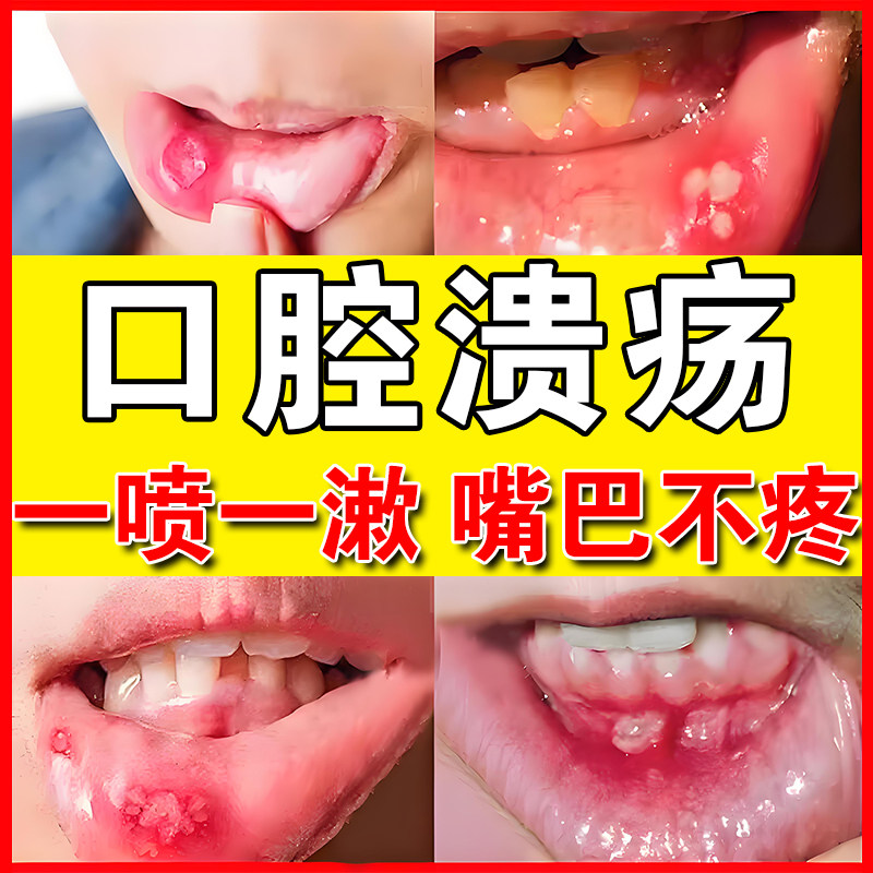 口腔i溃疡喷剂舌头溃疡嘴巴上火起泡生疮西瓜霜口疮舌炎溃疡喷雾