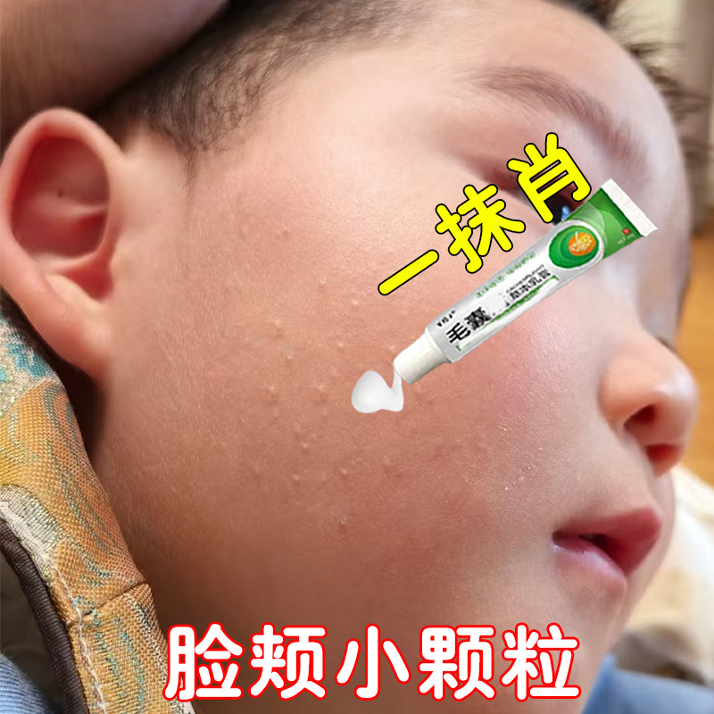 儿童脸上小颗粒毛周角化去除脸上白色小颗粒脂肪粒鸡皮疙瘩专用膏