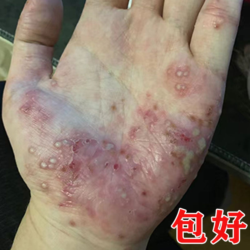 掌趾脓疱病症药治疗手脚脓包角化病蜕皮掌跖脓包红斑脱皮痒外用膏