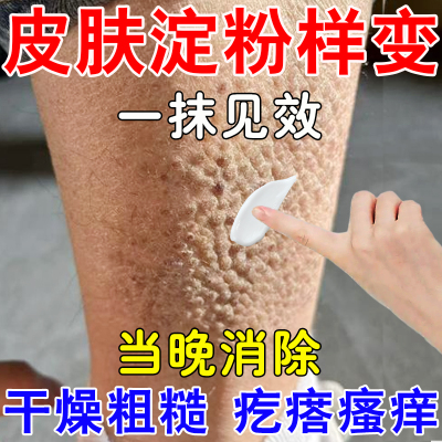 皮肤淀粉样变专用膏顽固皮藓止痒