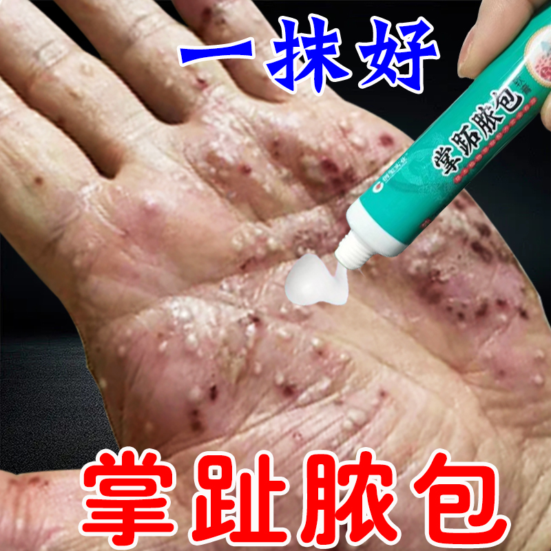 掌趾脓疱病症药治疗手脚脓包角化病蜕皮掌跖脓包红斑脱皮痒专用膏