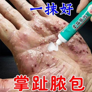 掌趾脓疱病症药治疗手脚脓包角化病蜕皮掌跖脓包红斑脱皮痒专用膏